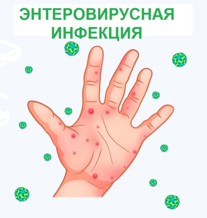 Что такое энтеровирусная инфекция?